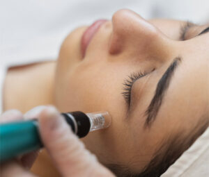 micro needling genzano