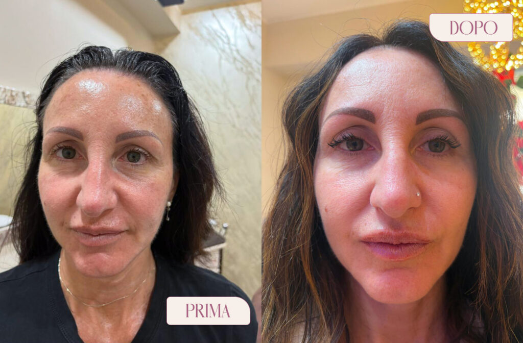 TRATTAMENTO MICRO NEEDLING PRIMA E DOPO